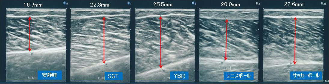 写真A／右足太もものMRI画像。太もも裏にヤムナボールを当てると、一見、筋肉が潰されているように錯覚するが、実は縦と横方向に大きく広がっているのがわかる。